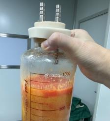 深圳水动力吸脂手术要做多久？